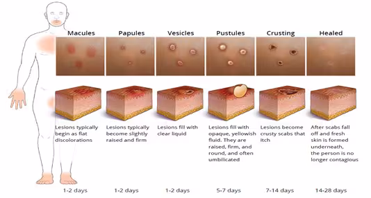 Stages of mpox lesions Shows the stages of mpox lesions from macules to scabs