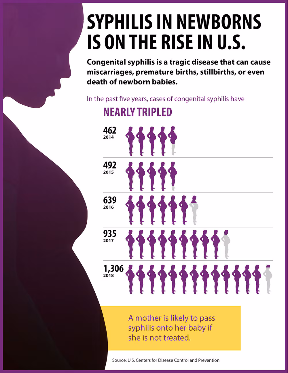 Syphilis in newborns is on the rise in the US