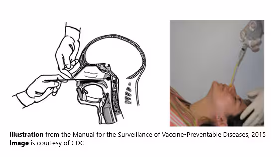NP techniques An illustration and image showing the proper technique for obtaining a nasopharyngeal specimen for isolation of Bordetella pertussis.