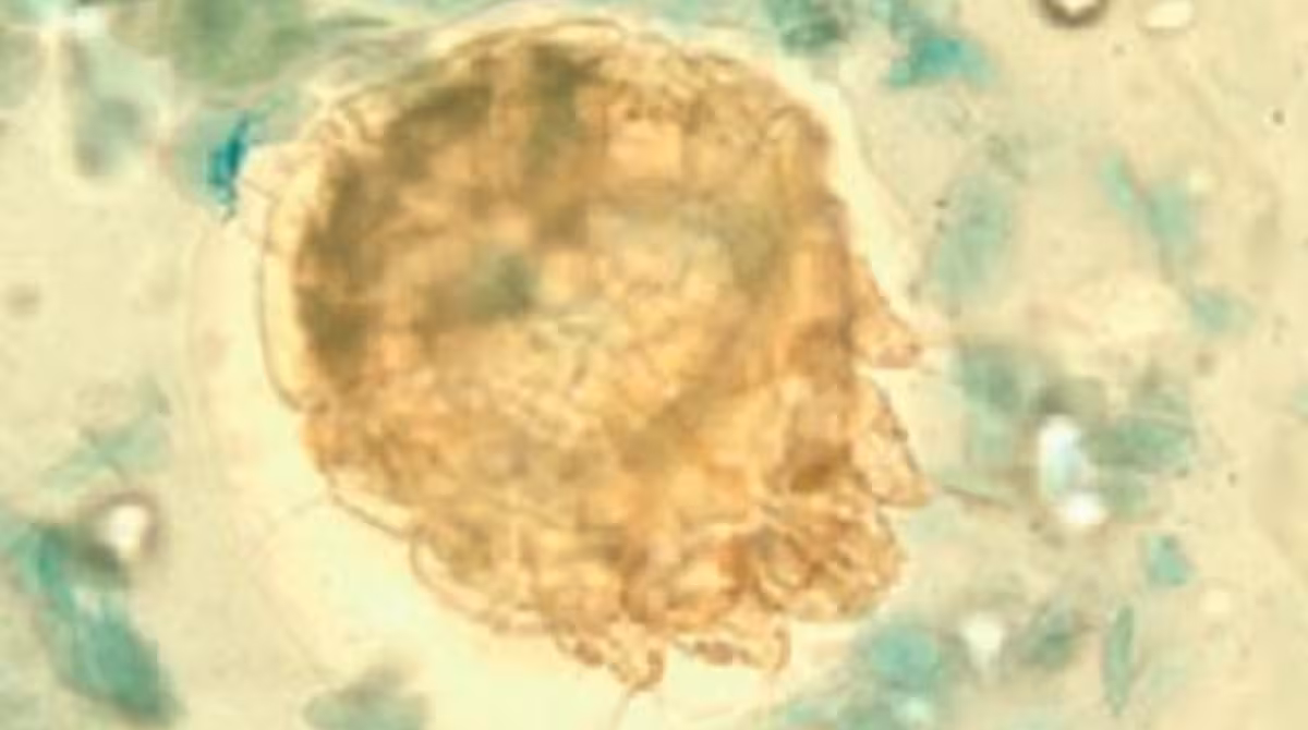 — title missing — Scabies