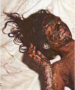 Hemorrhagic Smallpox A young woman lies on a bed, covered in bleeding smallpox pustules on her head, arm, hands, and chest.