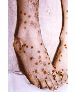 Modified-Type Smallpox Feet covered in smallpox lesions