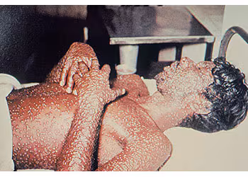 Clinical Ordinary Smallpox A male lies on a bed, covered in smallpox lesions