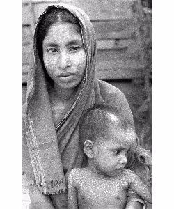 Smallpox Sequelae A woman holding a child, both with smallpox scars