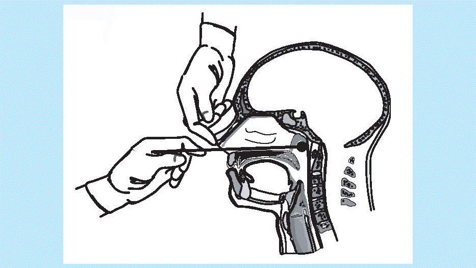 chapt22-figure01.gif Figure 1: Proper technique for obtaining a nasopharyngeal specimen for isolation of B. pertussis