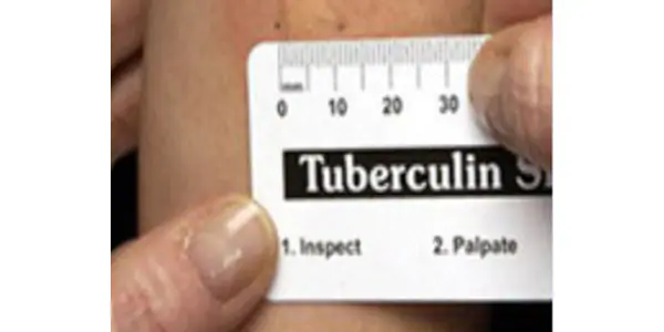 tst-ruler Ruler measuring induration on skin