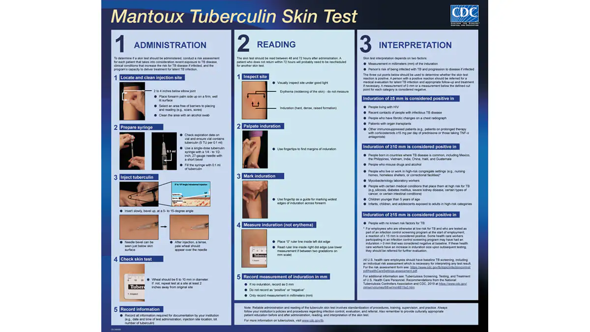 Mantoux Skin Test Wall Chart Mantoux Tuberculin Skin Test Wall Chart
