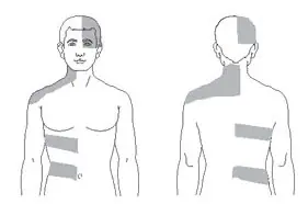 Shingles VIS illustration Line drawing of a male figure shown from the front and back, highlighting horizontal bands on the torso and back.