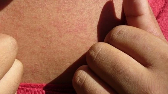 — title missing — Photograph of a person's skin with a rash caused by Zika.